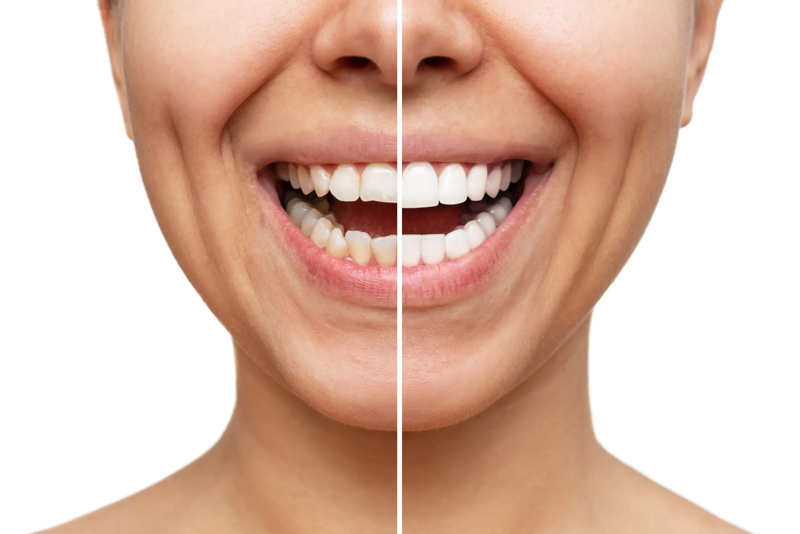 teeth whitening in karachi