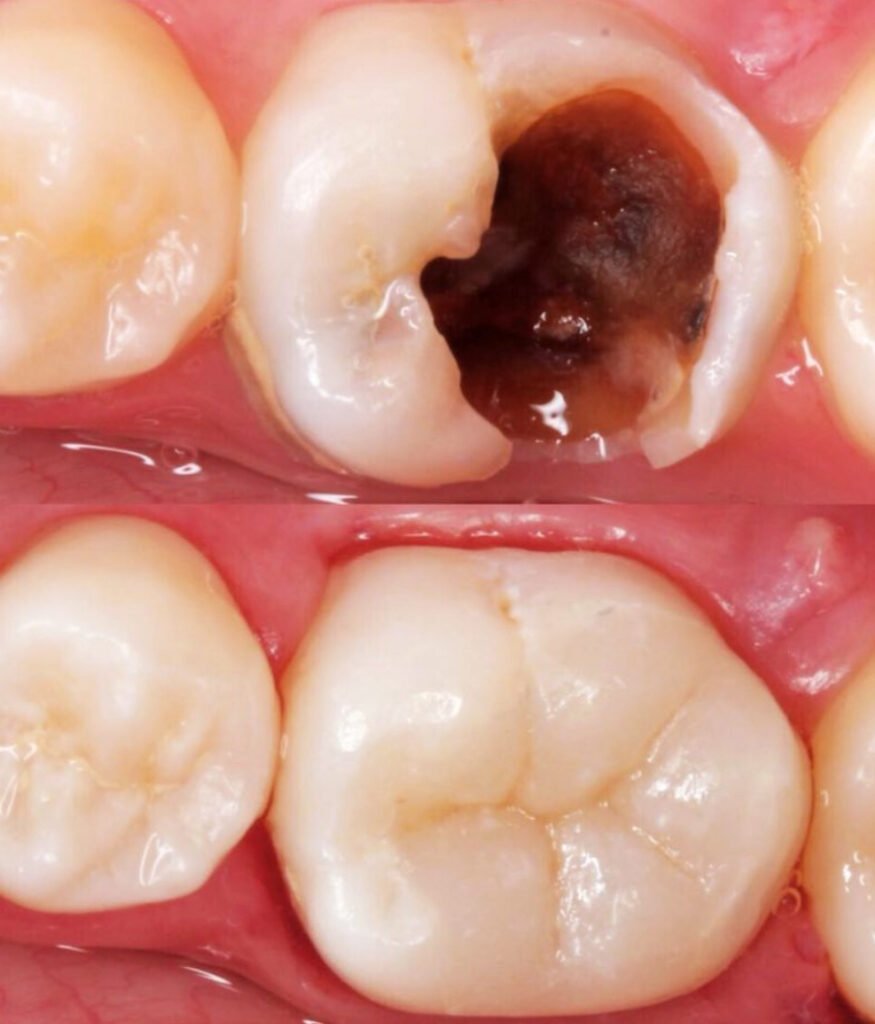 Teeth Filling in DHA Karachi