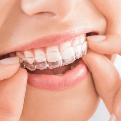 Clear Aligners