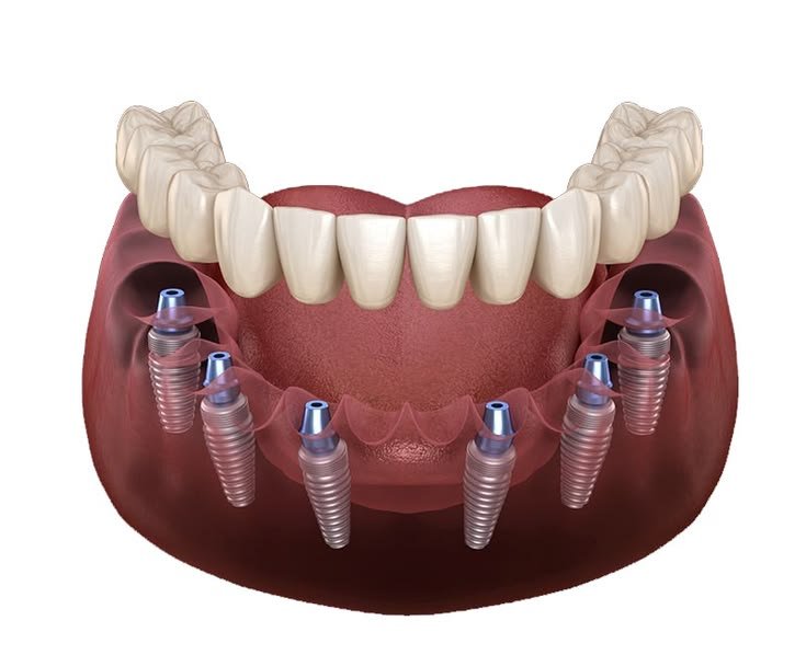 Multiple Teeth Implants