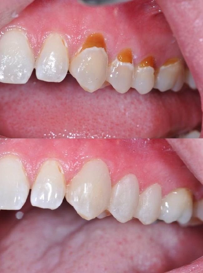 Composite fillings