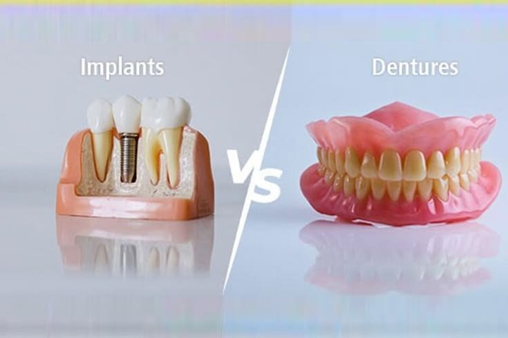 Dental Implants vs Bridges