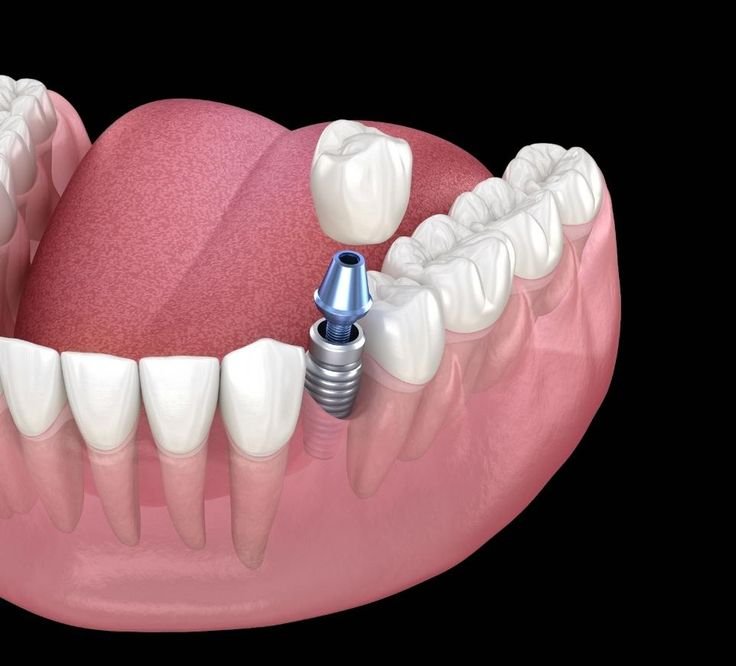 Single Tooth Implant