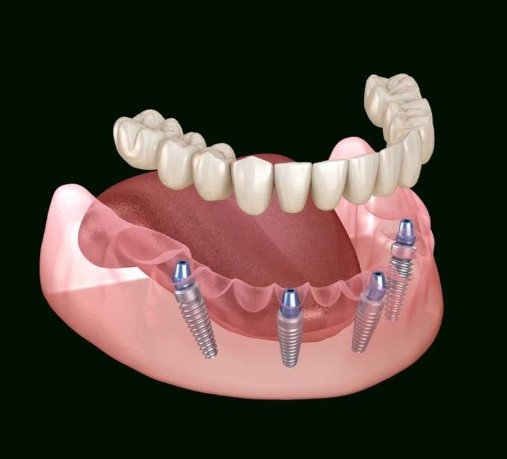 Implant-Supported Dentures