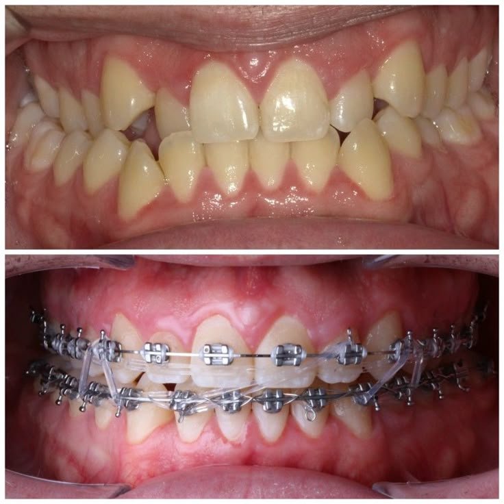 Ortodoncia, Brackets, Orthodontics