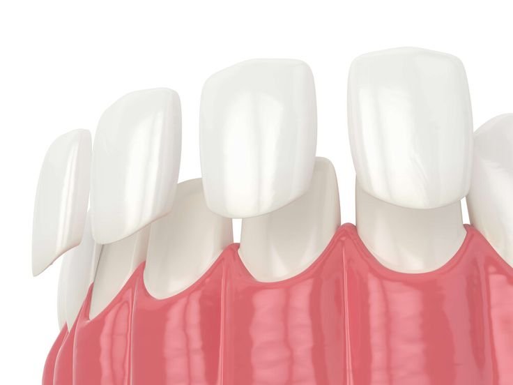 Teeth Veneers in DHA Karachi