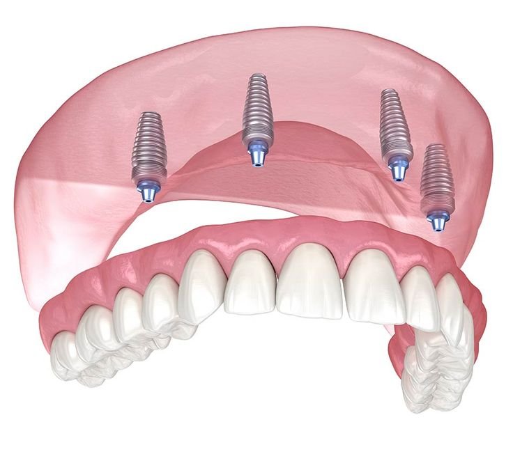 Dental Implants