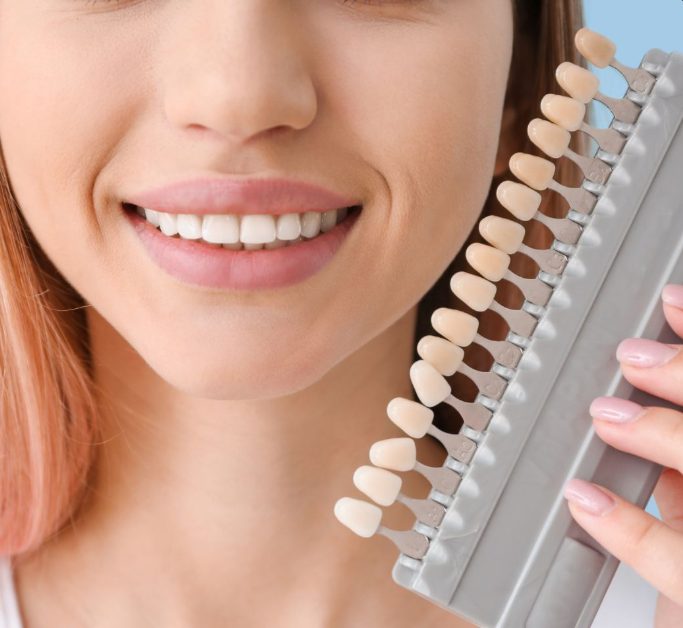 Teeth Veneers in DHA Karachi