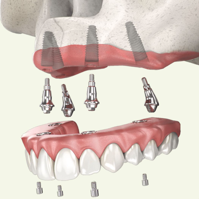 Implant-Supported Dentures