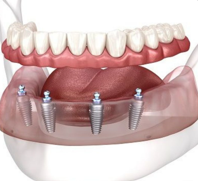 All-on-4 Implants