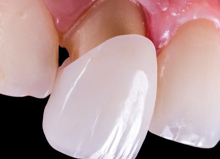 Teeth Veneers in DHA Karachi