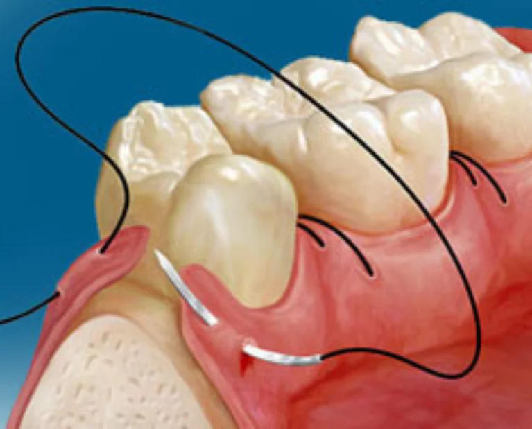 Minor Oral Surgeries?