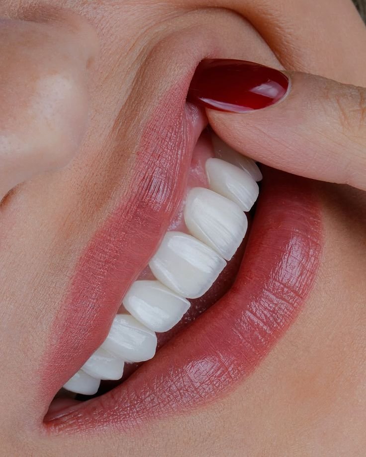 Teeth Veneers in DHA Karachi