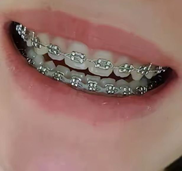 Metal Braces