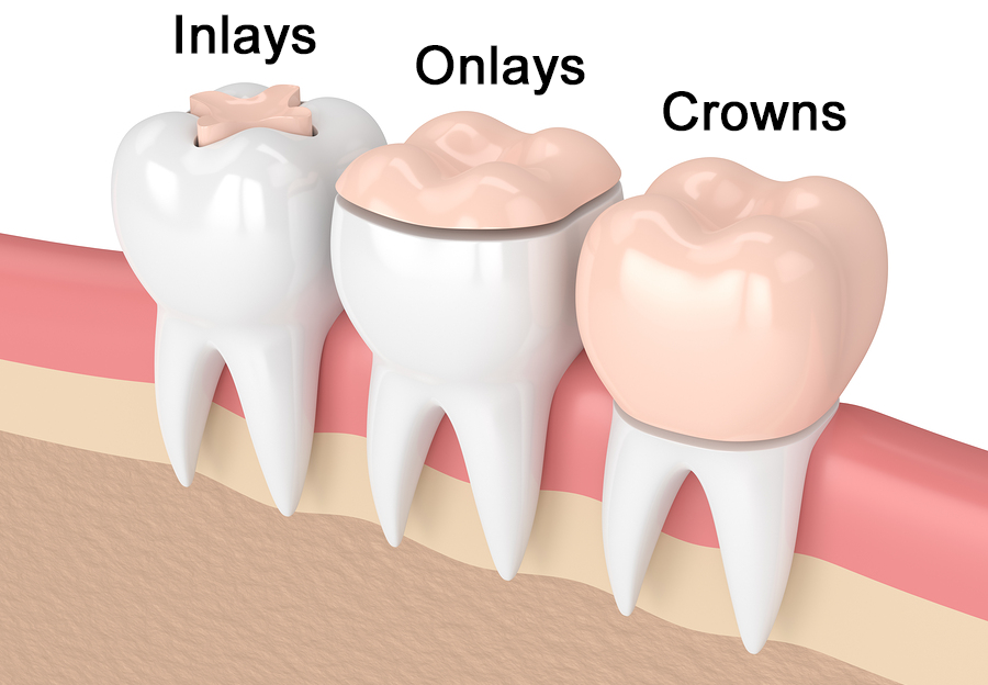 Ceramic Inlays and Onlays